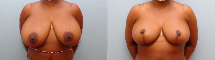 Before & After Breast Reduction Case 55 Front View in Anchorage, AK