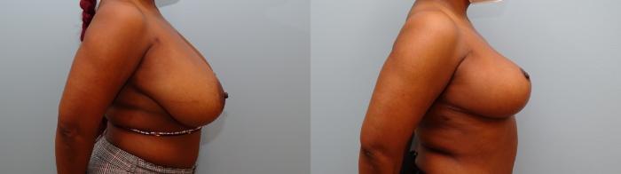 Before & After Breast Reduction Case 55 Right Side View in Anchorage, AK