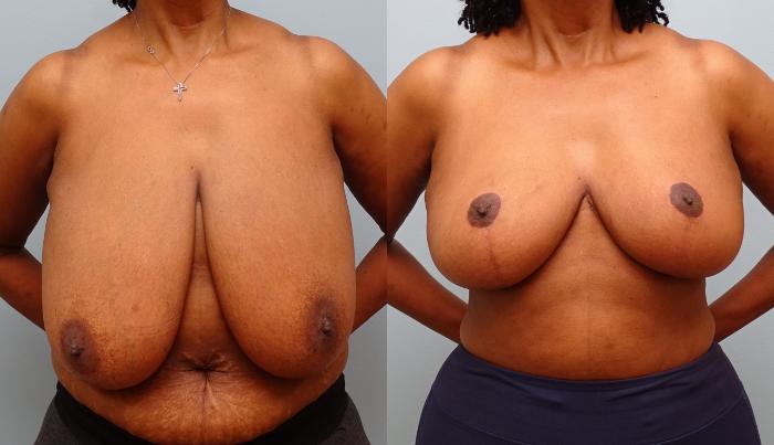 Before & After Breast Reduction Case 59 Front View in Anchorage, AK