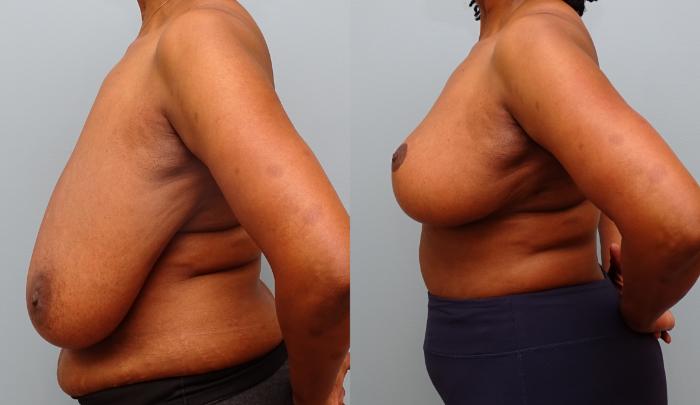 Before & After Breast Reduction Case 59 Left Side View in Anchorage, AK