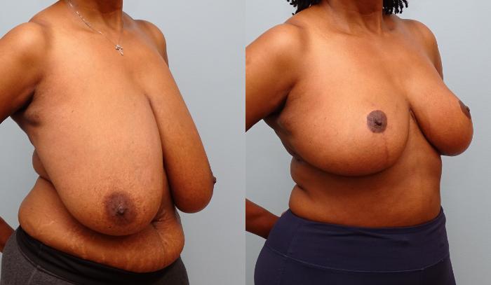 Before & After Breast Reduction Case 59 Right Oblique View in Anchorage, AK