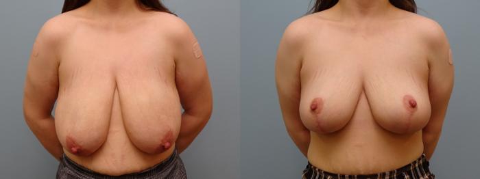 Before & After Breast Reduction Case 64 Front View in Anchorage, AK