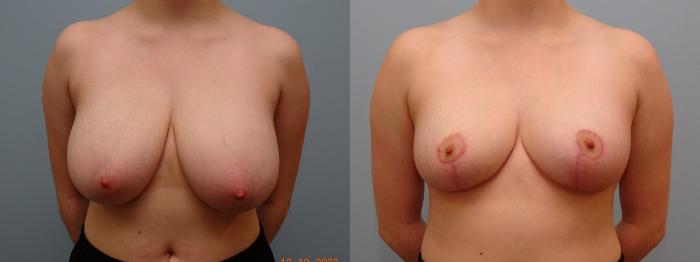 Before & After Breast Reduction Case 66 Front View in Anchorage, AK