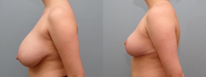 Before & After Breast Reduction Case 66 Left Side View in Anchorage, AK