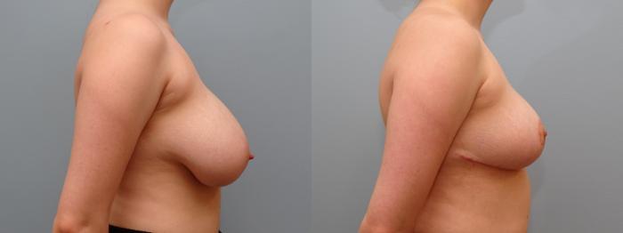 Before & After Breast Reduction Case 66 Right Side View in Anchorage, AK