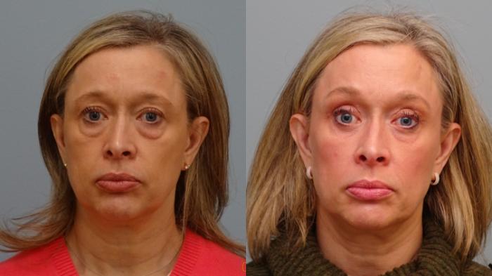 Before & After Brow Lift Case 81 Front View in Anchorage, AK