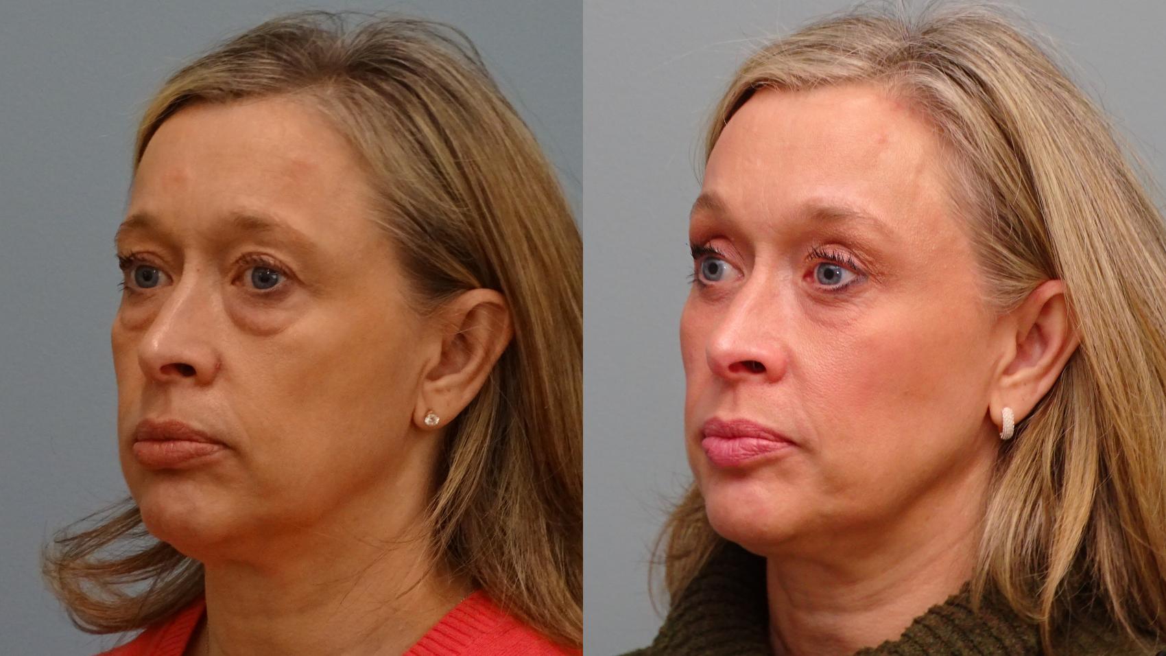 Before & After Brow Lift Case 81 Left Oblique View in Anchorage, AK