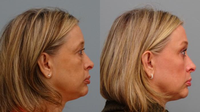 Before & After Brow Lift Case 81 Right Side View in Anchorage, AK