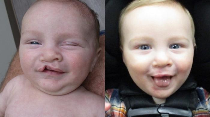 Before & After Cleft Lip & Palate Case 32 Front View in Anchorage, AK