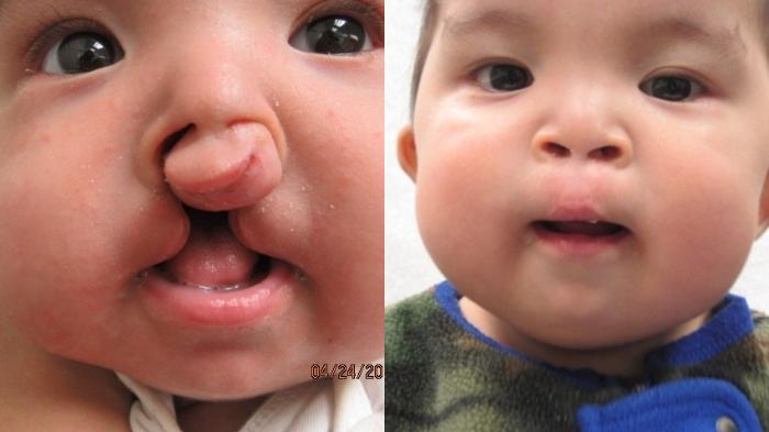 Before & After Cleft Lip & Palate Case 35 Front View in Anchorage, AK