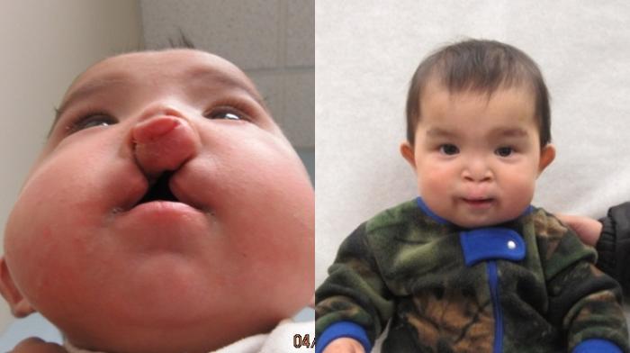 Before & After Cleft Lip & Palate Case 35 Right Side View in Anchorage, AK