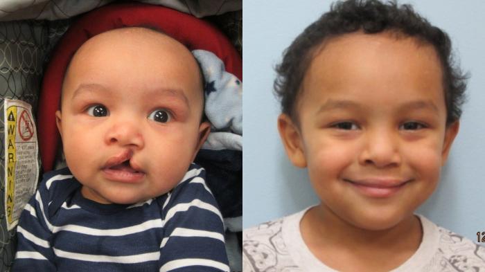 Before & After Cleft Lip & Palate Case 36 Front View in Anchorage, AK