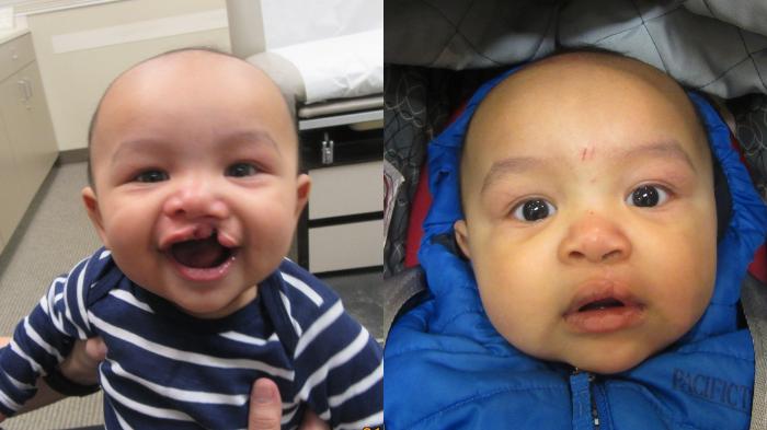 Before & After Cleft Lip & Palate Case 36 Left Side View in Anchorage, AK