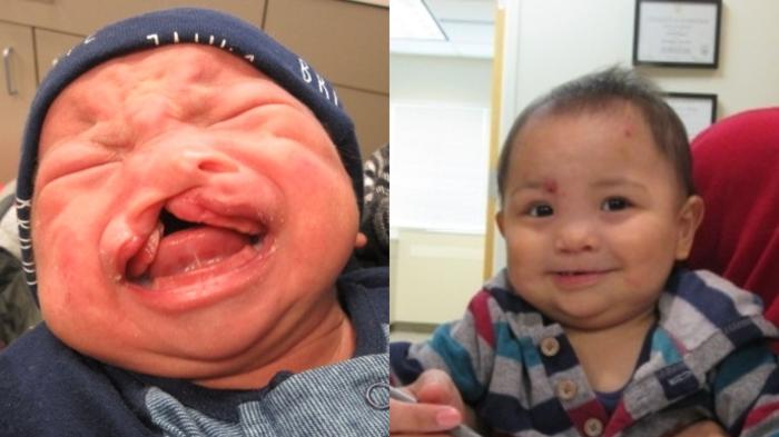 Before & After Cleft Lip & Palate Case 37 Front View in Anchorage, AK