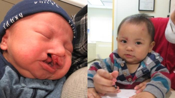 Before & After Cleft Lip & Palate Case 37 Right Side View in Anchorage, AK