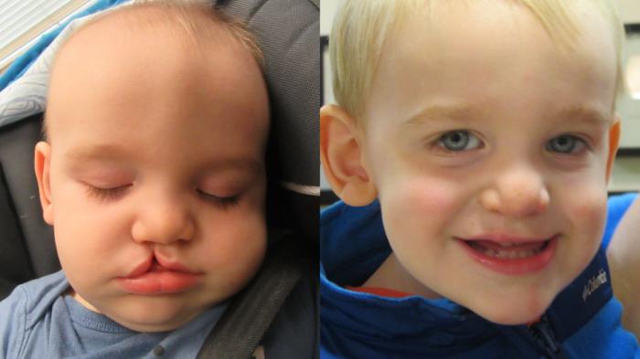Before & After Cleft Lip & Palate Case 38 Right Side View in Anchorage, AK