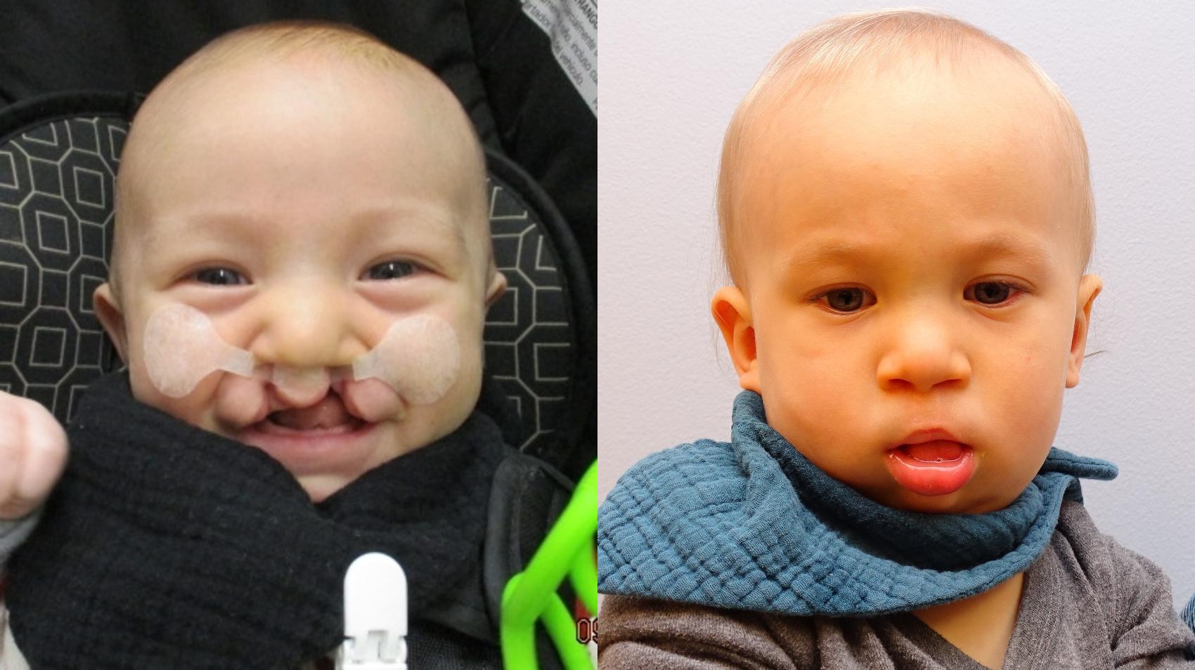 Before & After Cleft Lip & Palate Case 85 Face View in Anchorage, AK