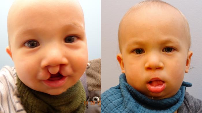 Before & After Cleft Lip & Palate Case 85 Front View in Anchorage, AK