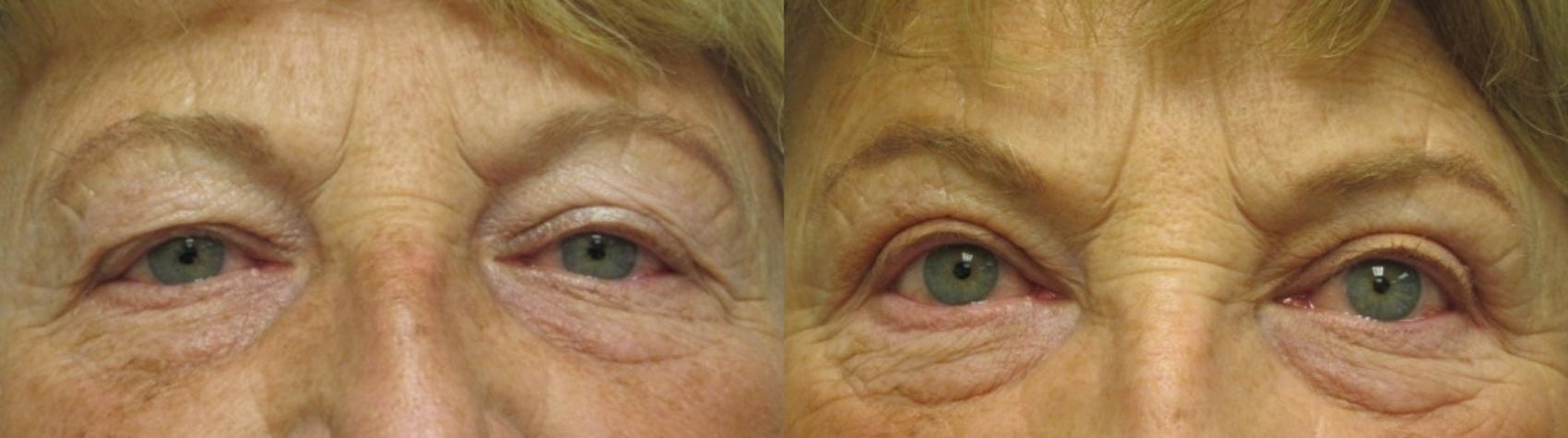 Before & After Eyelid Surgery Case 17 Front View in Anchorage, AK