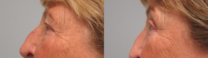 Before & After Eyelid Surgery Case 17 Left Side View in Anchorage, AK