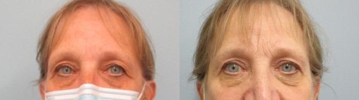 Before & After Eyelid Surgery Case 44 Front View in Anchorage, AK