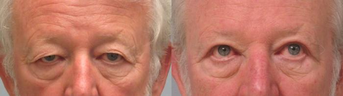 Before & After Eyelid Surgery Case 50 Front View in Anchorage, AK
