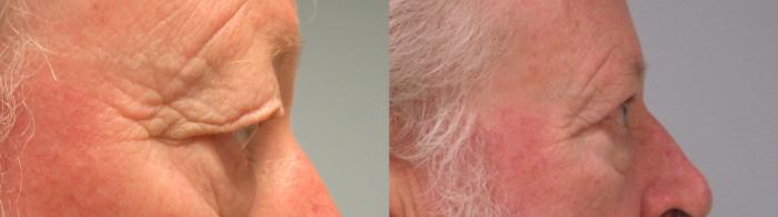 Before & After Eyelid Surgery Case 50 Right Side View in Anchorage, AK