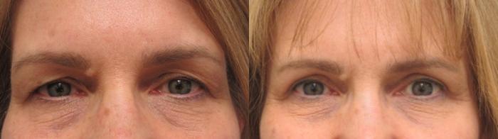 Before & After Eyelid Surgery Case 51 Front View in Anchorage, AK