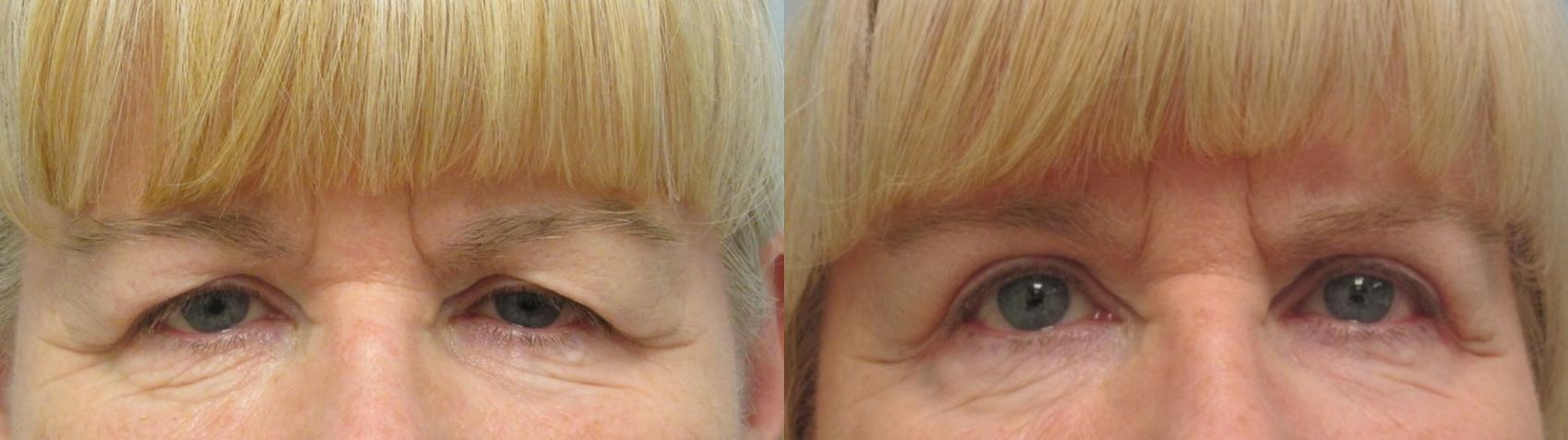 Before & After Eyelid Surgery Case 52 Front View in Anchorage, AK