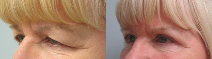 Before & After Eyelid Surgery Case 52 Left Oblique View in Anchorage, AK