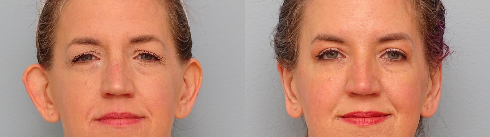 Before & After Eyelid Surgery Case 54 Front View in Anchorage, AK