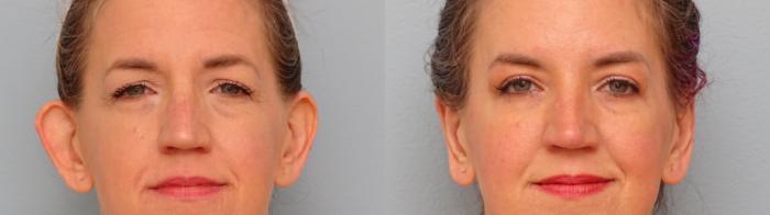 Before & After Eyelid Surgery Case 54 Front View in Anchorage, AK