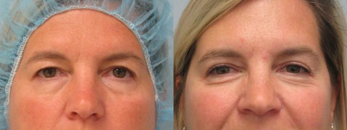 Before & After Eyelid Surgery Case 72 Front View in Anchorage, AK
