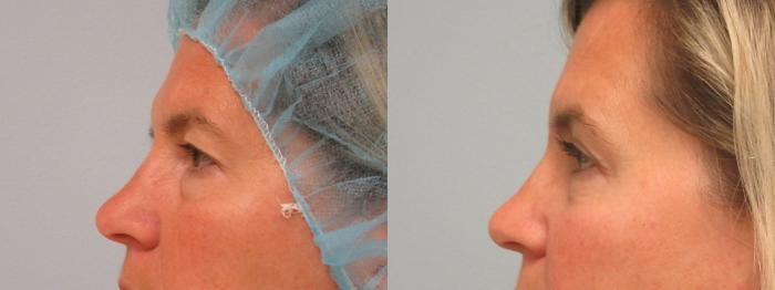 Before & After Eyelid Surgery Case 72 Left Side View in Anchorage, AK