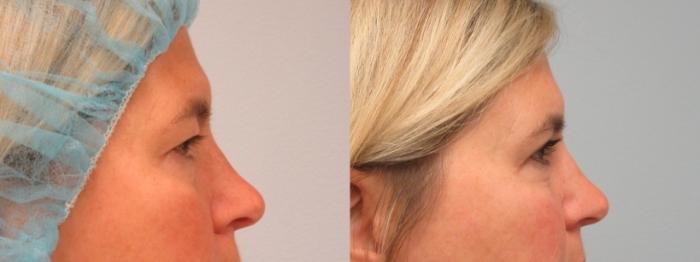 Before & After Eyelid Surgery Case 72 Right Side View in Anchorage, AK