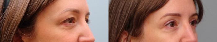 Before & After Eyelid Surgery Case 89 Right Oblique View in Anchorage, AK
