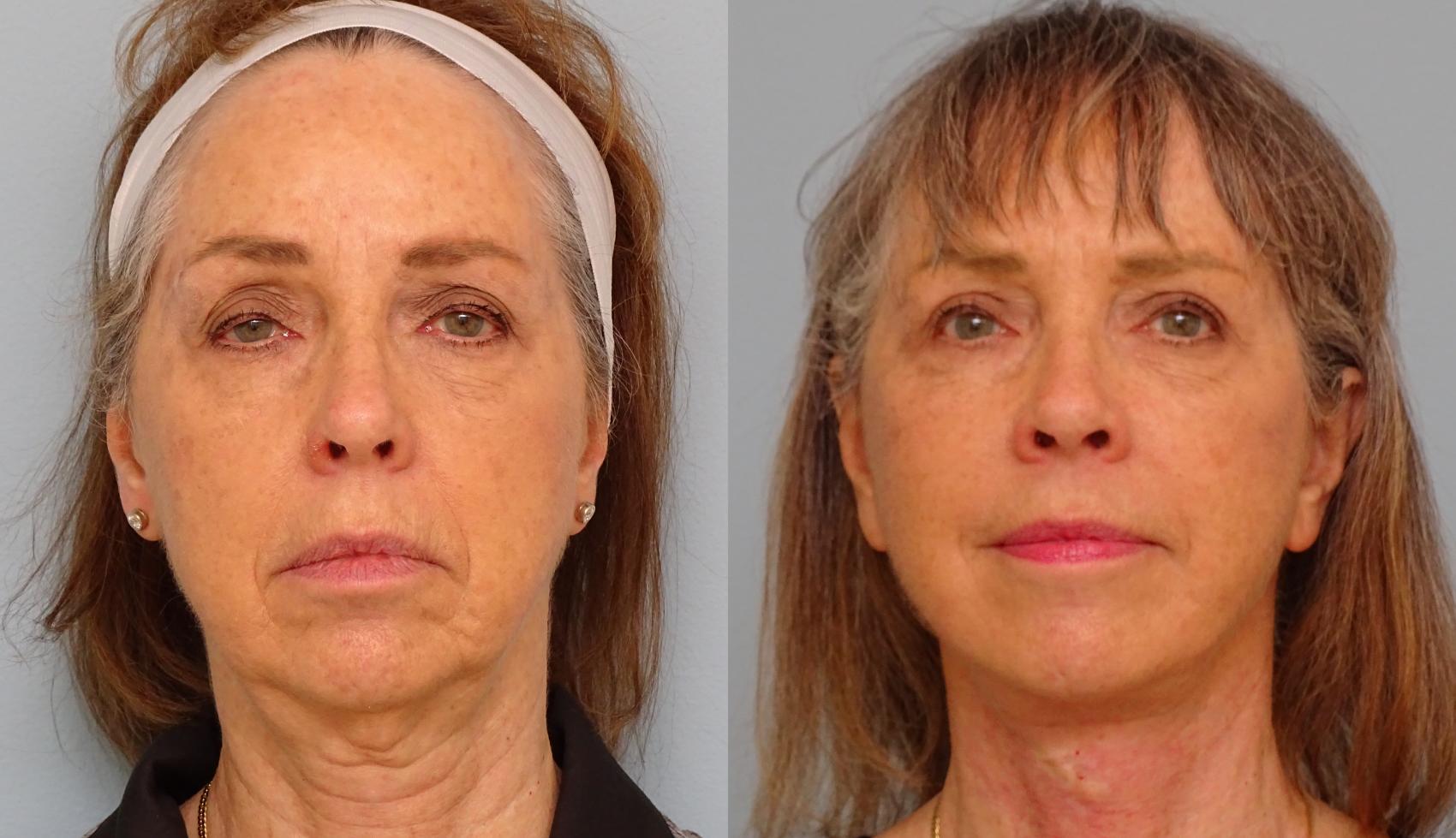 Before & After Facelift & Neck Lift Case 56 Front View in Anchorage, AK