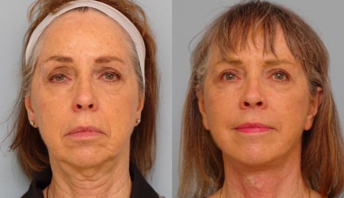 Before & After Eyelid Surgery Case 56 Front View in Anchorage, AK