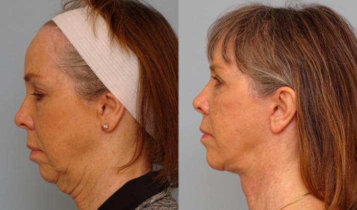 Before & After Eyelid Surgery Case 56 Left Side View in Anchorage, AK