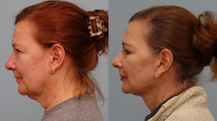 Before & After Facelift & Neck Lift Case 78 Left Side View in Anchorage, AK