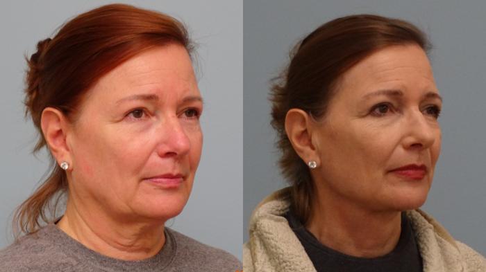 Before & After Facelift & Neck Lift Case 78 Right Oblique View in Anchorage, AK