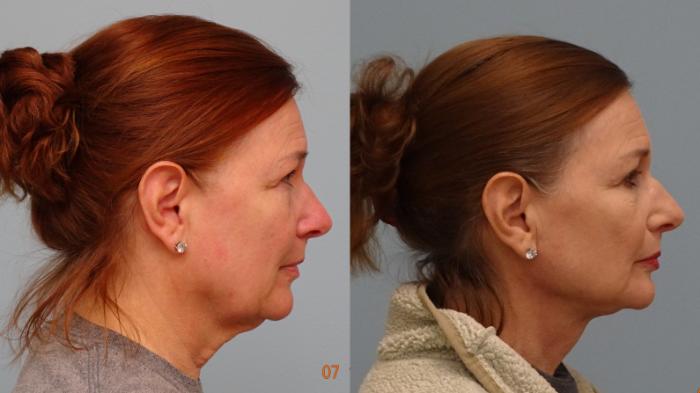 Before & After Facelift & Neck Lift Case 78 Right Side View in Anchorage, AK