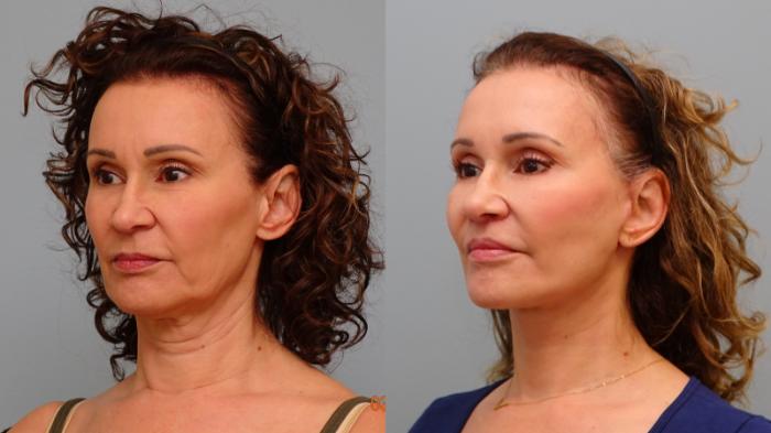 Before & After Facelift & Neck Lift Case 80 Left Oblique View in Anchorage, AK