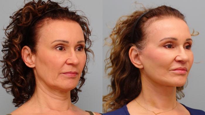 Before & After Facelift & Neck Lift Case 80 Right Oblique View in Anchorage, AK