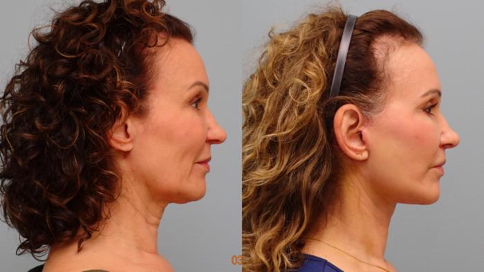 Before & After Facelift & Neck Lift Case 80 Right Side View in Anchorage, AK