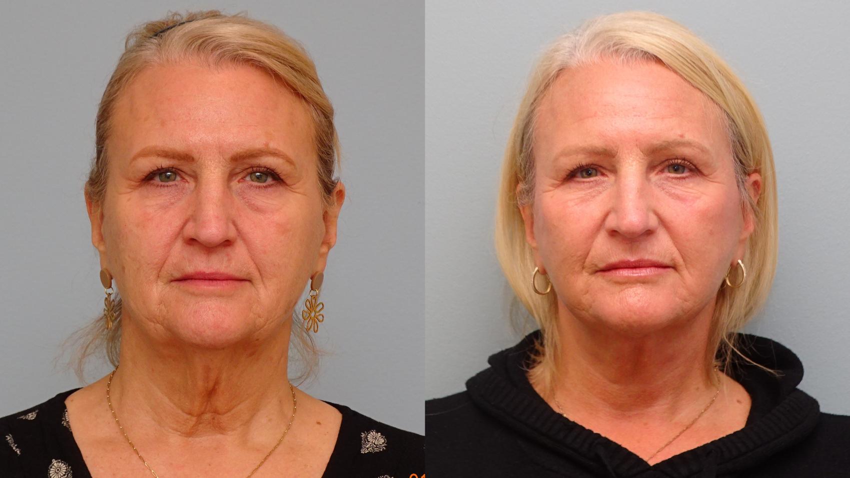 Before & After Facelift & Neck Lift Case 84 Front View in Anchorage, AK