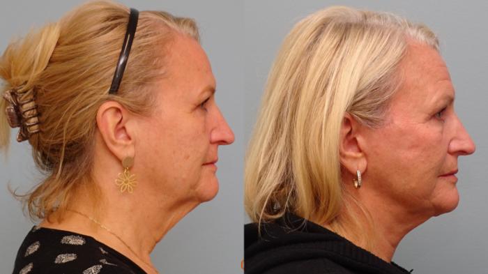 Before & After Facelift & Neck Lift Case 84 Left Side View in Anchorage, AK