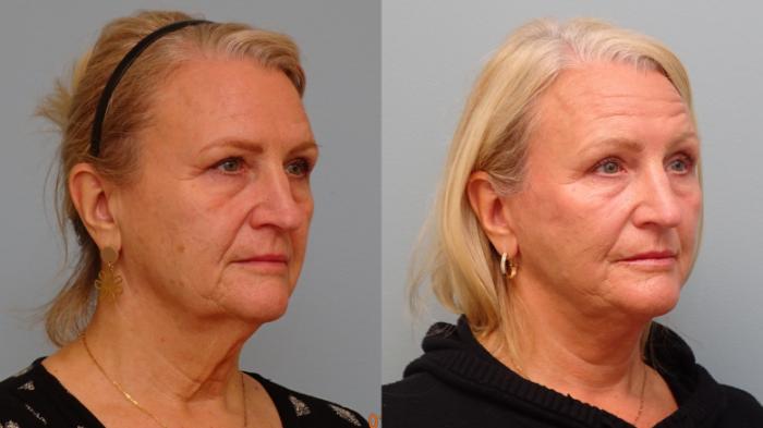 Before & After Facelift & Neck Lift Case 84 Right Oblique View in Anchorage, AK