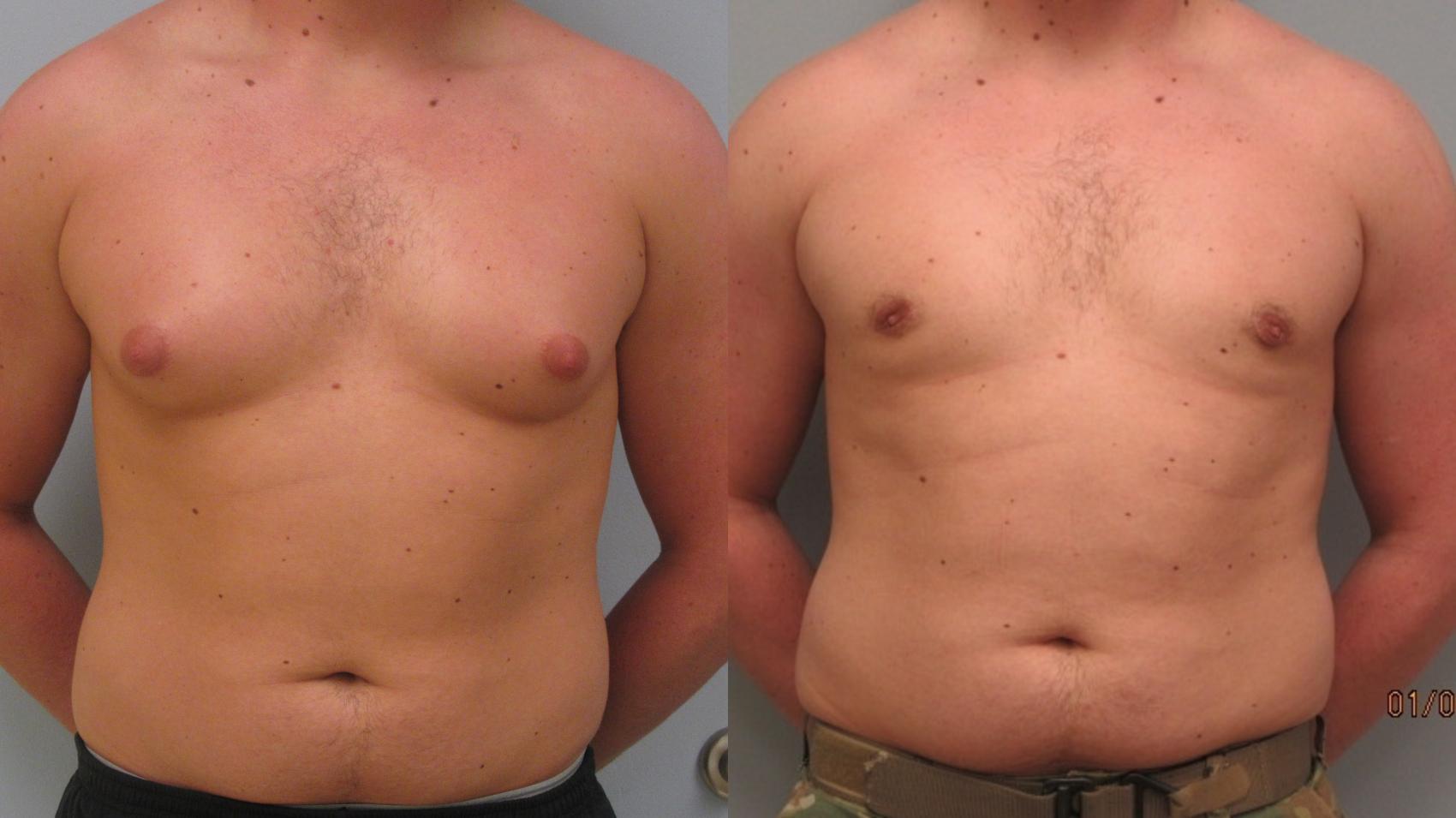 Before & After Gynecomastia Surgery Case 13 Front View in Anchorage, AK