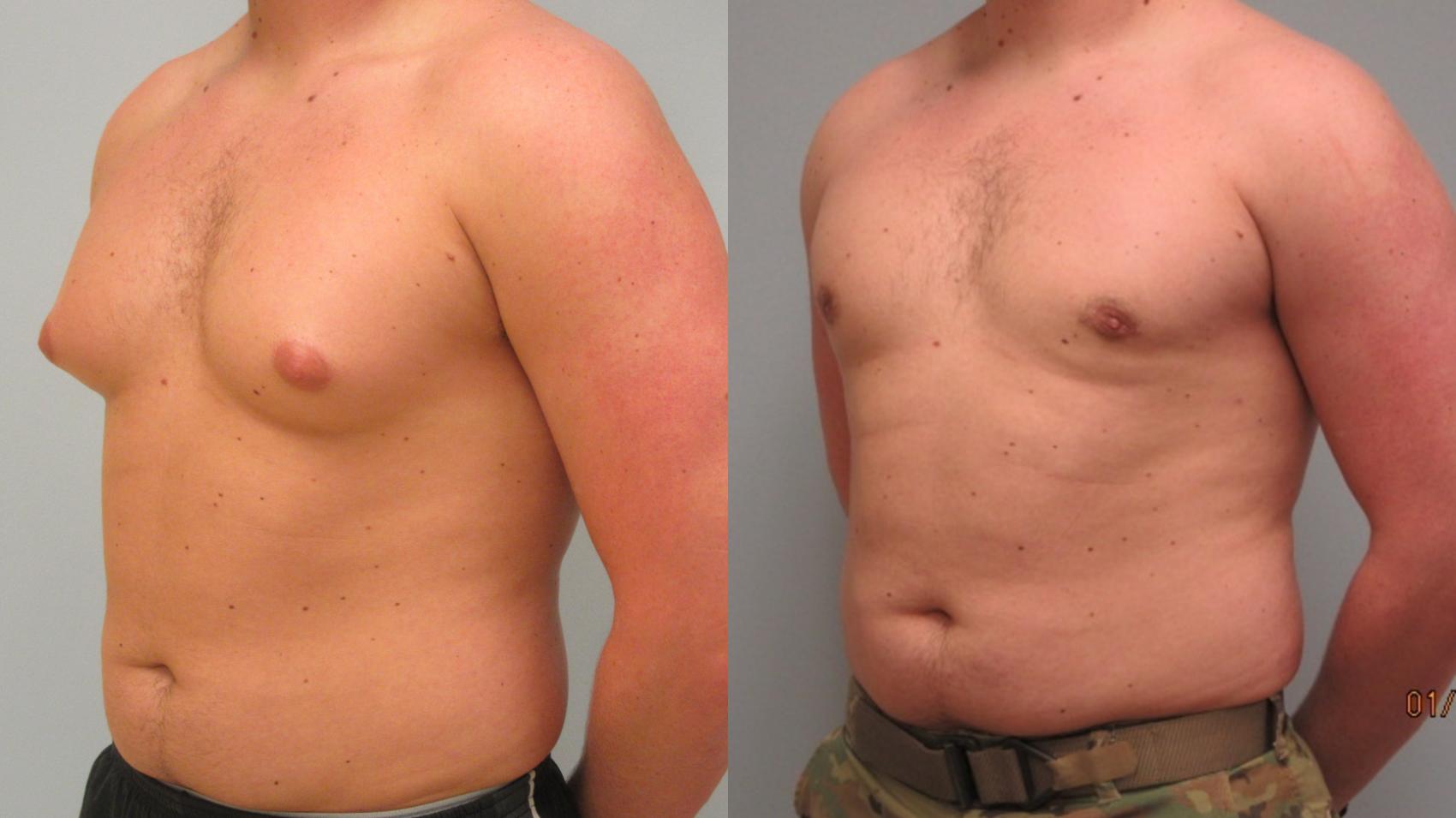 Before & After Gynecomastia Surgery Case 13 Left Oblique View in Anchorage, AK